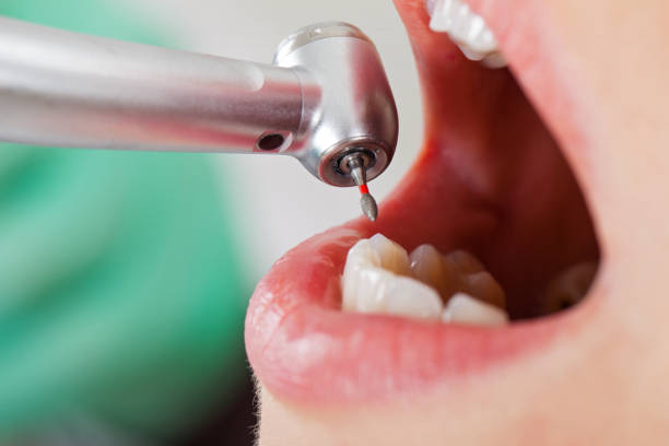 Best Emergency Tooth Extraction in Mono Vista, CA